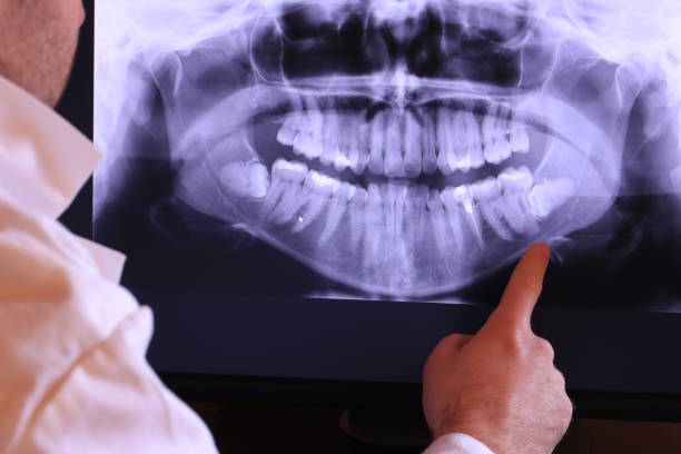 Best Knocked-Out Tooth (Avulsed Tooth) Treatment in USA